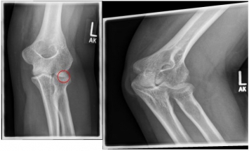 Ellenbogen Ellenbogen